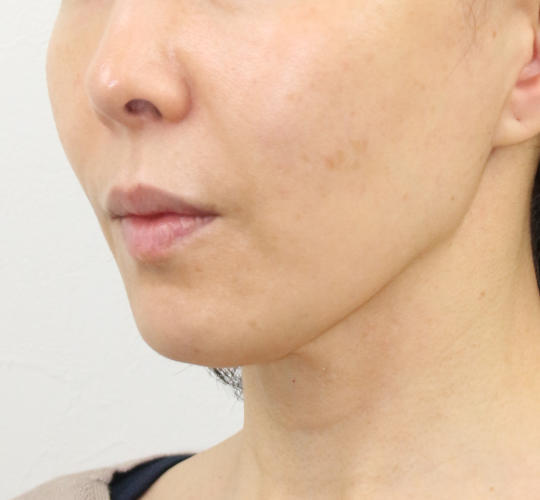 50代女性のVOVリフトプレミアム After 症例写真