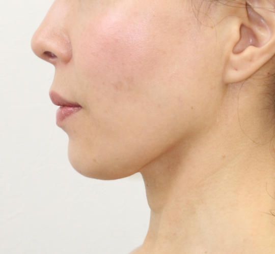 50代女性のVOVリフトプレミアム After 症例写真