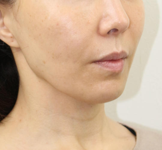 50代女性のVOVリフトプレミアム After 症例写真