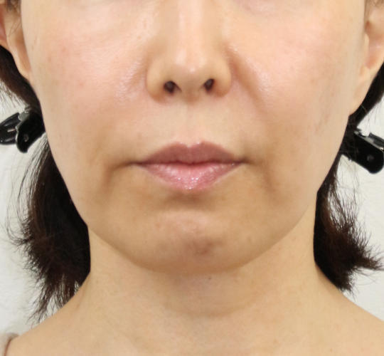 50代女性のVOVリフトプレミアム Before 症例写真