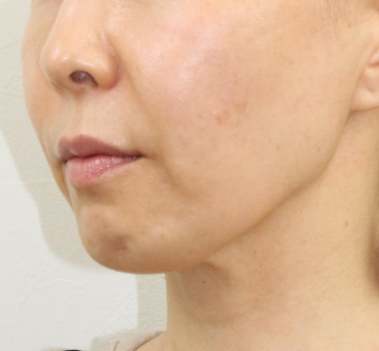 50代女性のVOVリフトプレミアム Before 症例写真