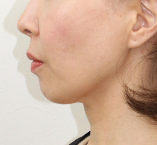 50代女性のVOVリフトプレミアム Before 症例写真