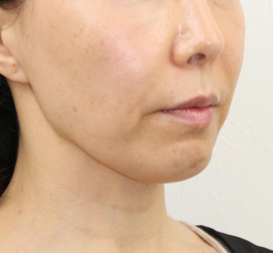 50代女性のVOVリフトプレミアム Before 症例写真