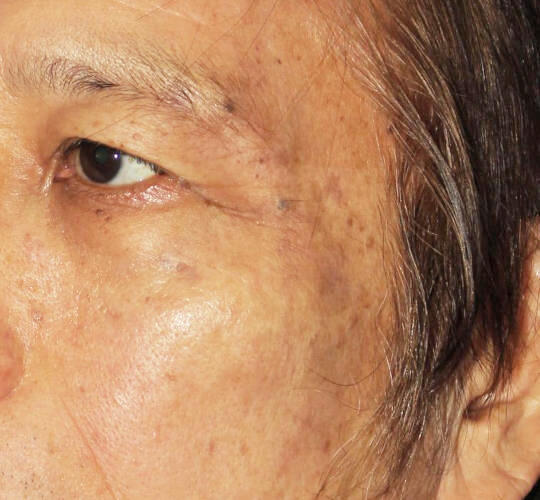 70代男性のリバースピール After 症例写真