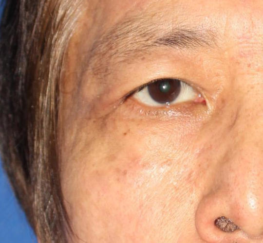 70代男性のリバースピール After 症例写真