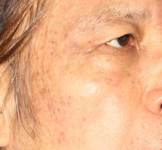 70代男性のメディカル美肌セレクト After 症例写真