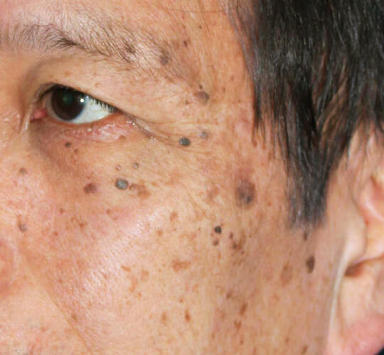 70代男性のリバースピール Before 症例写真