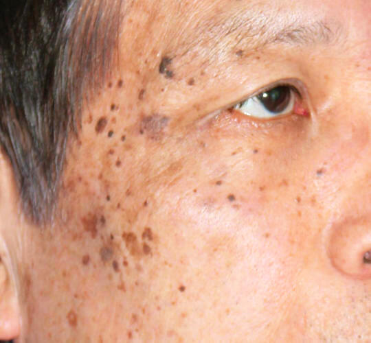 70代男性のメディカル美肌セレクト Before 症例写真