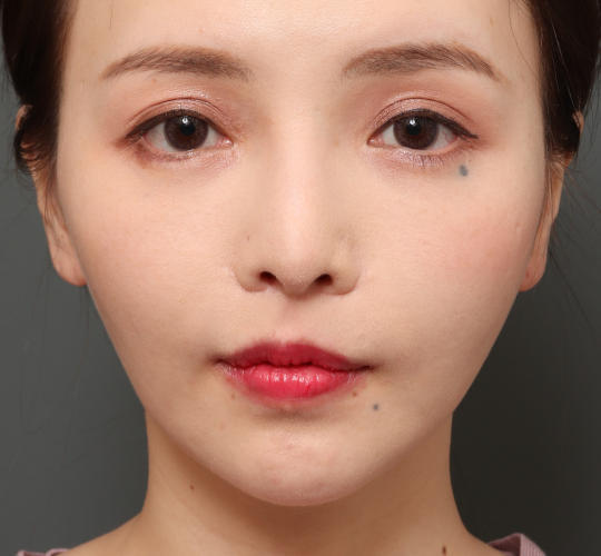 30代女性のM字リップ形成 After 症例写真