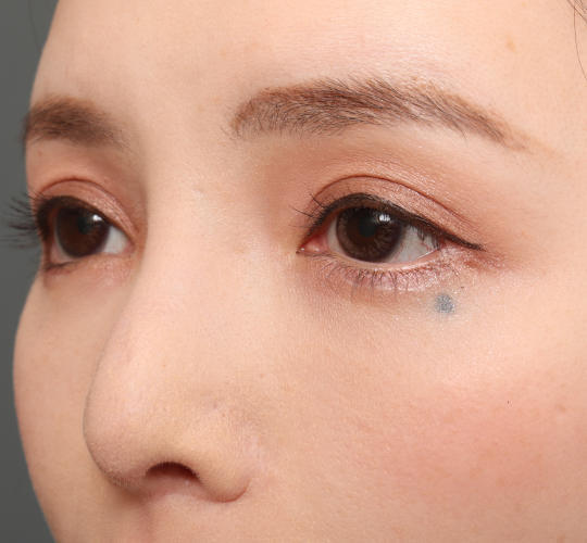 30代女性のM字リップ形成 After 症例写真