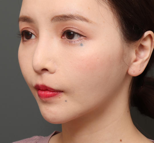 30代女性の唇・口元の整形 After 症例写真