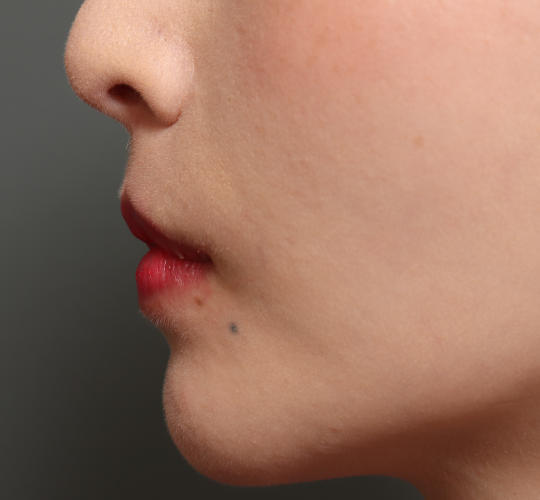 30代女性のM字リップ形成 After 症例写真