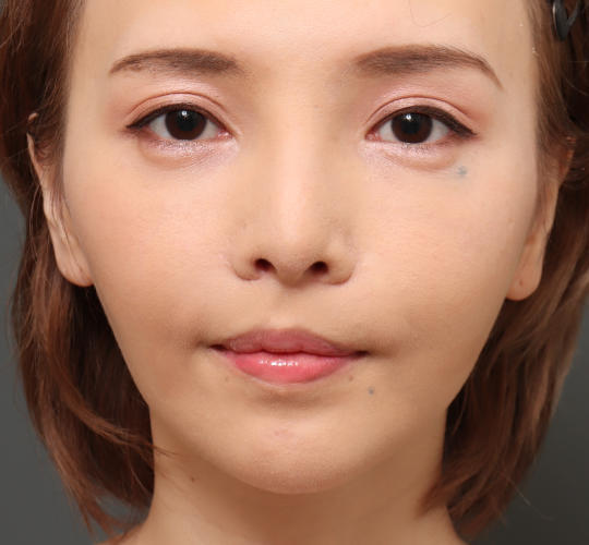 30代女性のM字リップ形成 Before 症例写真