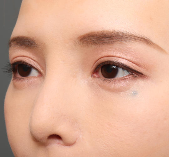 30代女性のM字リップ形成 Before 症例写真