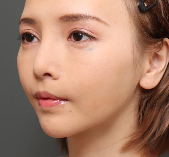 30代女性の唇・口元の整形 Before 症例写真