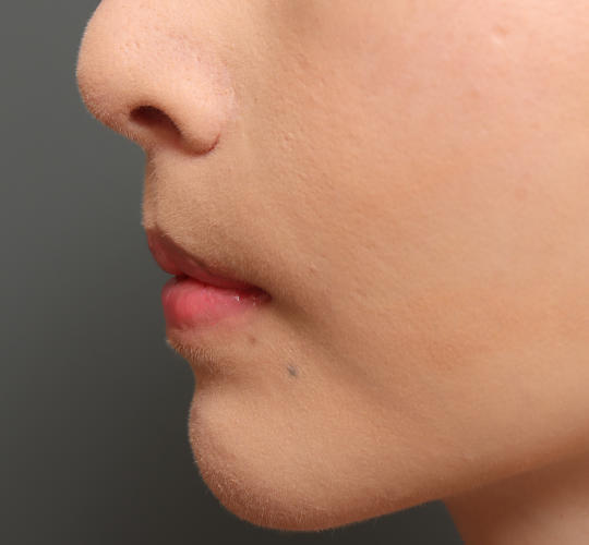 30代女性のM字リップ形成 Before 症例写真