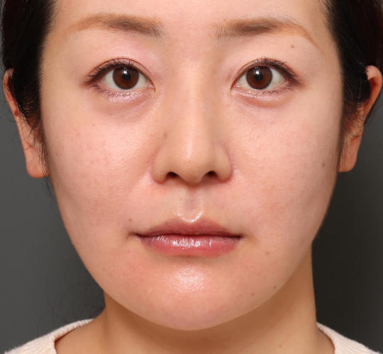 30代女性のM字リップ形成 Before 症例写真