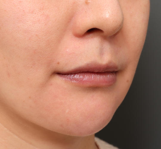 30代女性のM字リップ形成 Before 症例写真
