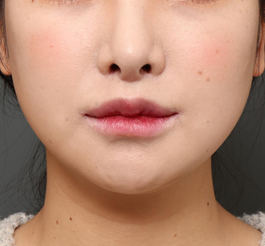 20代女性の人中短縮(リップリフト) After 症例写真