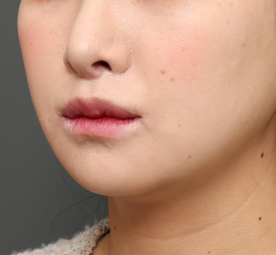 20代女性の人中短縮(リップリフト) After 症例写真
