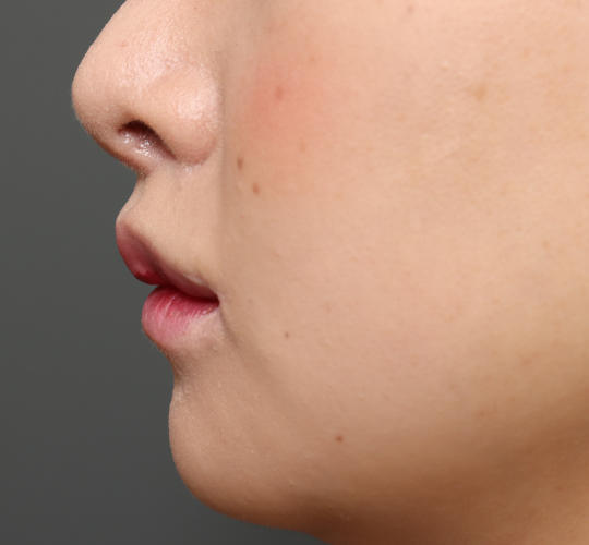 20代女性の人中短縮(リップリフト) After 症例写真