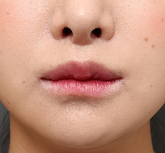 20代女性の人中短縮(リップリフト) After 症例写真