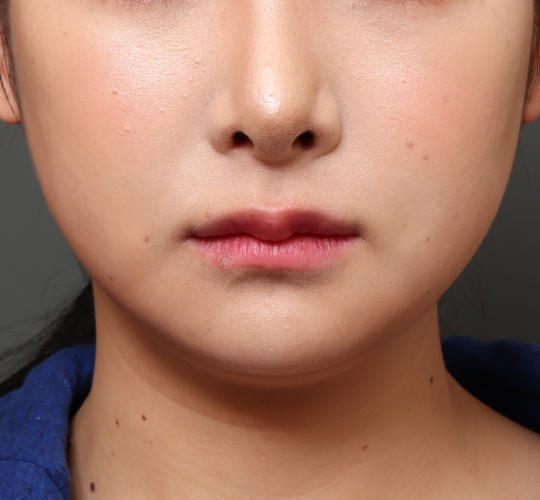 20代女性の人中短縮(リップリフト) Before 症例写真