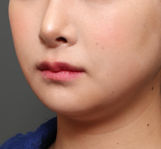 20代女性の人中短縮(リップリフト) Before 症例写真