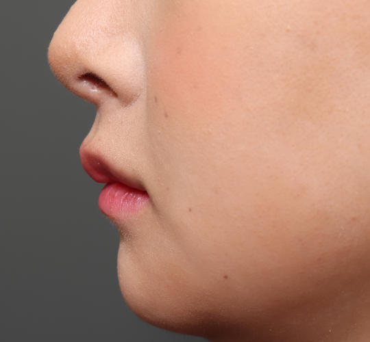 20代女性の人中短縮(リップリフト) Before 症例写真