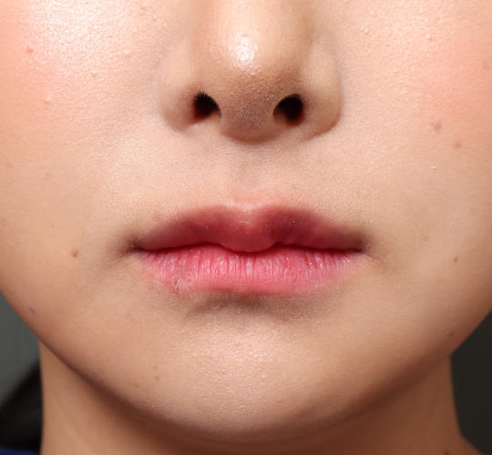 20代女性の人中短縮(リップリフト) Before 症例写真