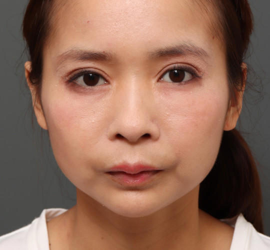 20代女性のアゴプロテーゼ（アゴ整形） After 症例写真