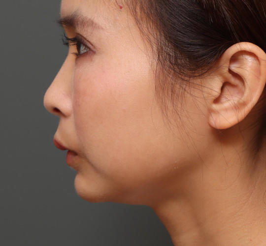 20代女性のアゴプロテーゼ（アゴ整形） After 症例写真