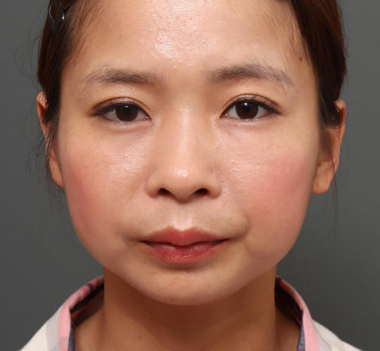 20代女性のアゴプロテーゼ（アゴ整形） Before 症例写真