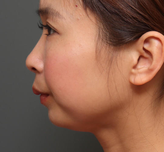 20代女性のアゴプロテーゼ（アゴ整形） Before 症例写真