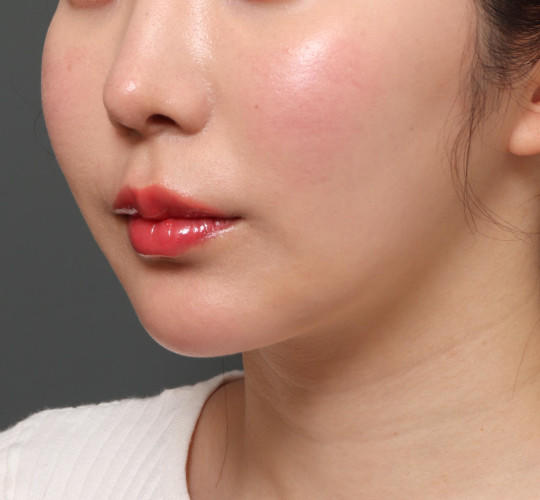 20代女性の人中短縮（リップリフト） Before 症例写真