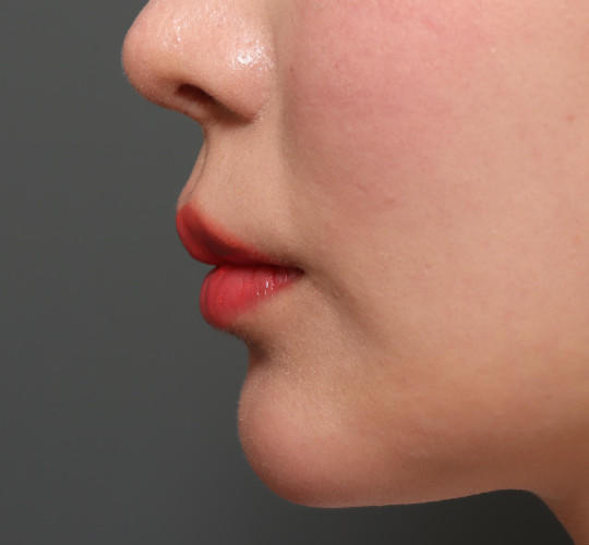 20代女性の人中短縮（リップリフト） Before 症例写真
