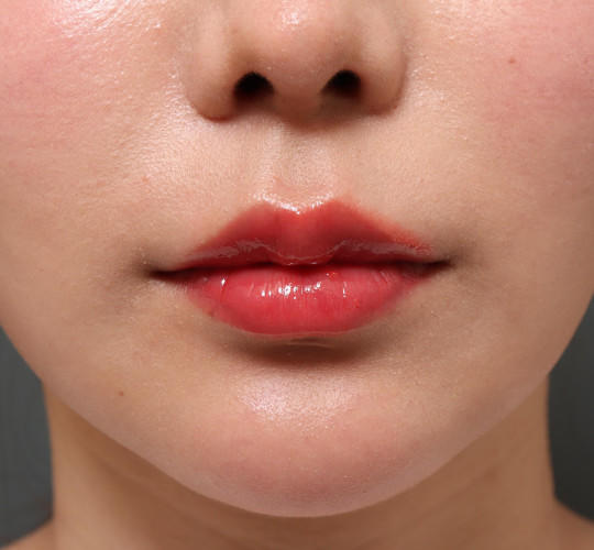 20代女性の人中短縮（リップリフト） Before 症例写真