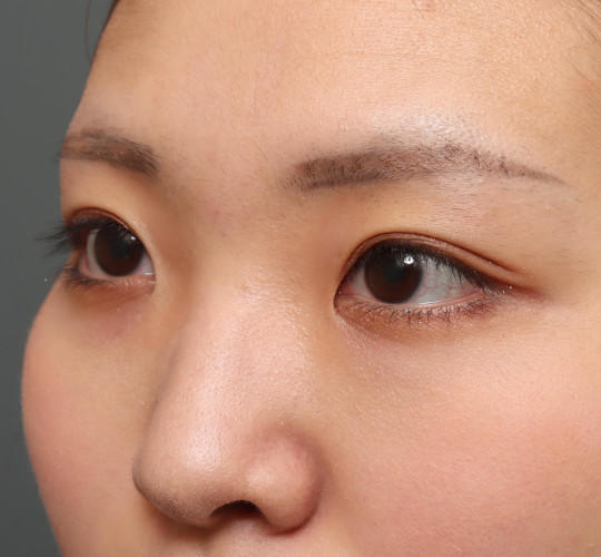 20代女性の二重埋没法 Before 症例写真