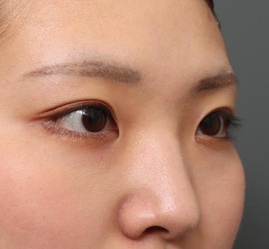 20代女性の二重埋没法 Before 症例写真