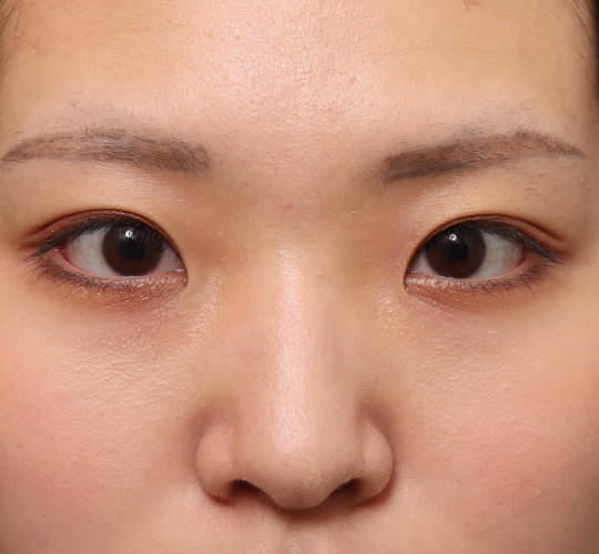 20代女性の二重埋没法 Before 症例写真