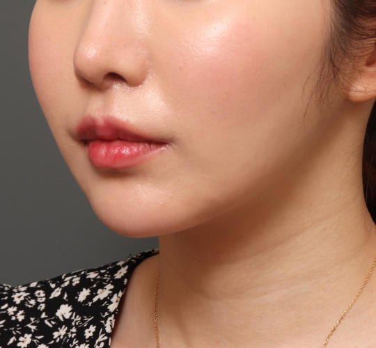 20代女性の人中短縮（リップリフト） After 症例写真