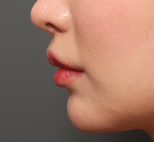 20代女性の人中短縮（リップリフト） After 症例写真
