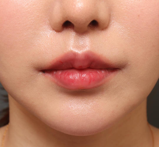 20代女性の人中短縮（リップリフト） After 症例写真