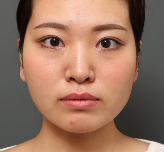 目頭切開の症例写真 公式 オザキクリニック 美容整形 美容外科 美容皮膚科 東京新宿 目黒祐天寺 羽村