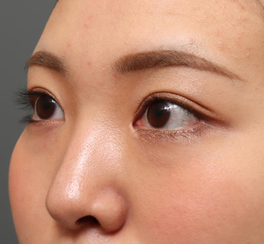 20代女性の二重埋没法 After 症例写真