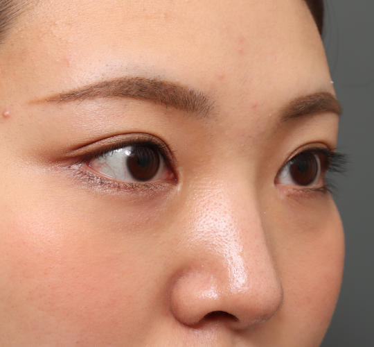 20代女性の二重埋没法 After 症例写真