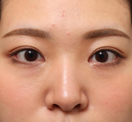 20代女性の二重埋没法 After 症例写真