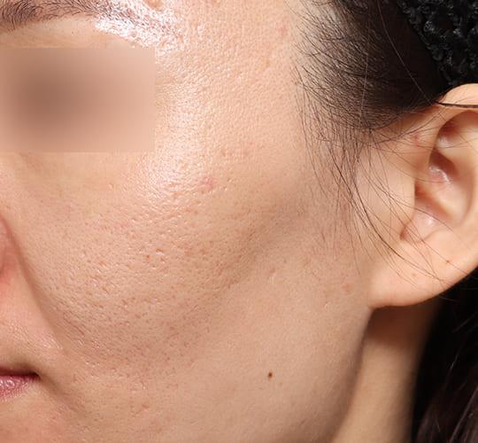 30代女性のサブシジョン After 症例写真