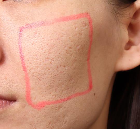 30代女性のサブシジョン Before 症例写真