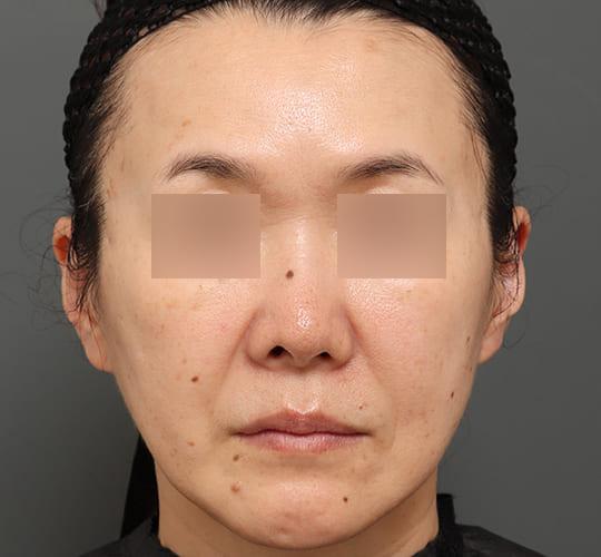 50代女性のヒアルロン酸注射 After 症例写真